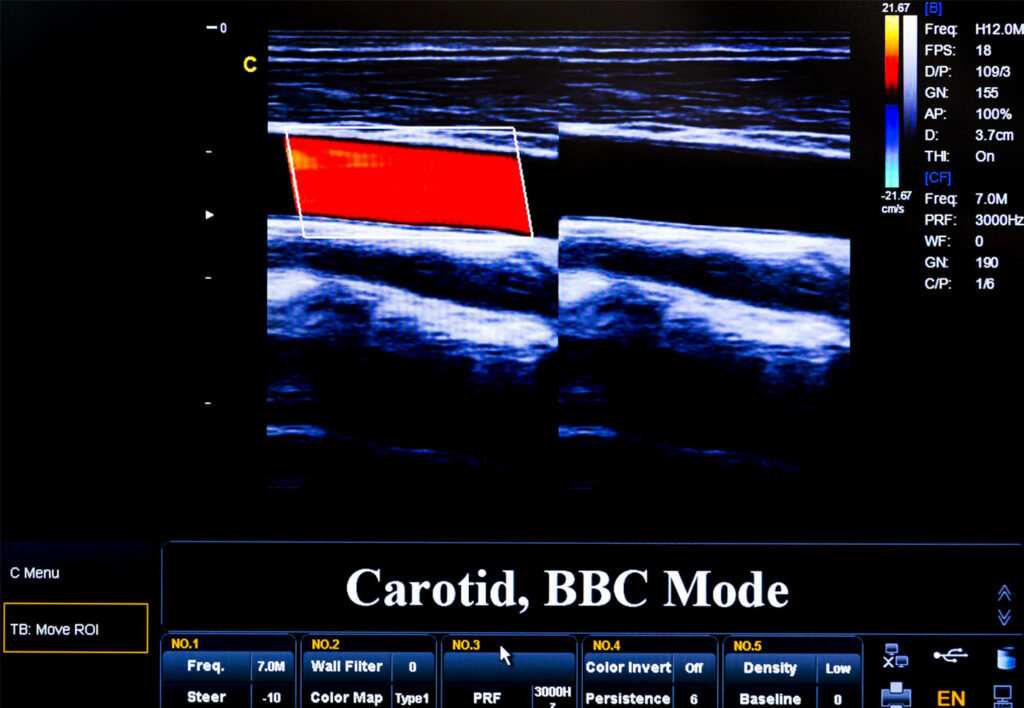 Colourful Ultrasound Monitor Image Carotid Artery