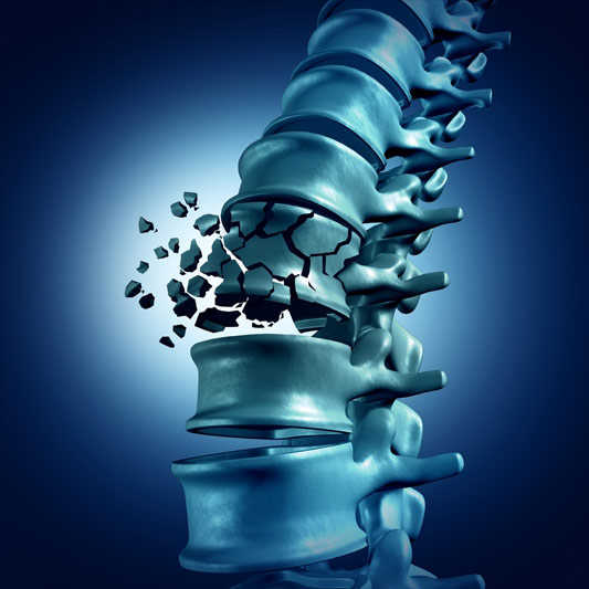 Spinal Fracture Medical