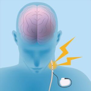 Human Brain Vagus Nerve Stimulation VNS Image Illustration